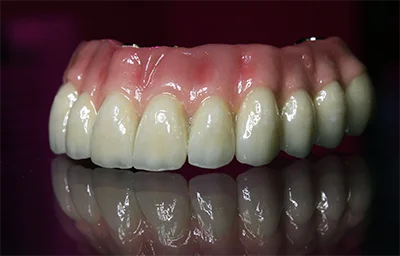 Full Arch Dental Implant Bridge