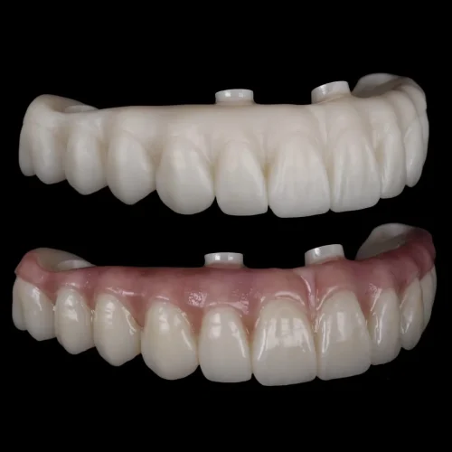 Full Arch Dental Implants Fabricated at Peak Dental Lab